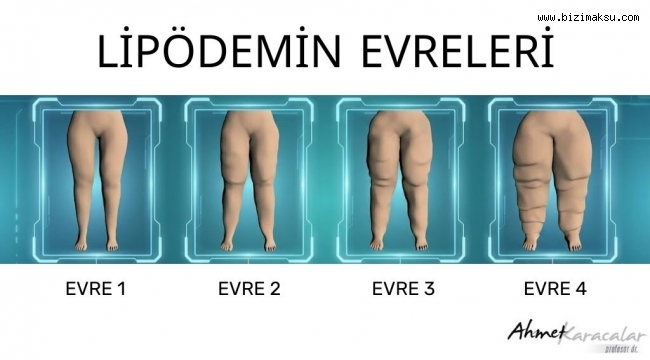 KİLO VEREMİYORSANIZ SUÇLU İRADENİZ DEĞİL, LİPÖDEM OLABİLİR