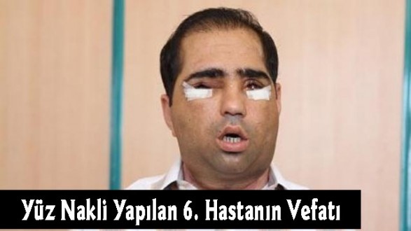 Yüz Nakli Yapılan 6. Hastanın Vefatı